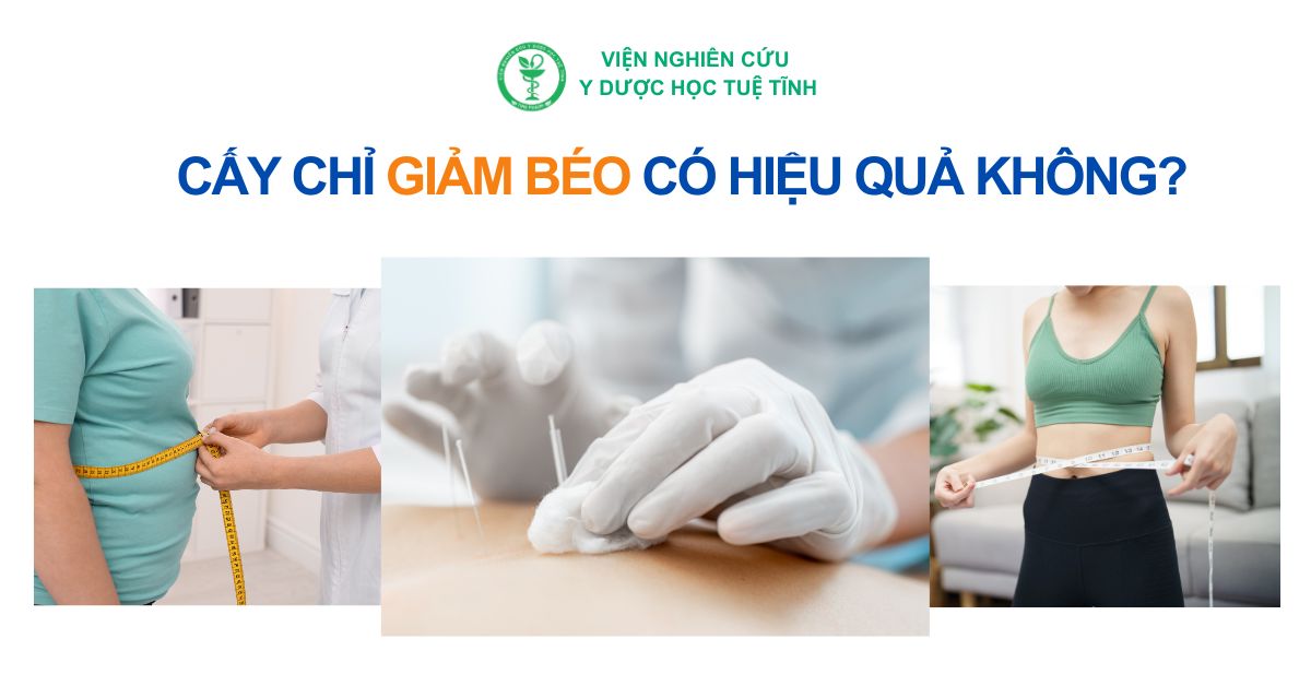 Cấy chỉ giảm béo có hiệu quả không?