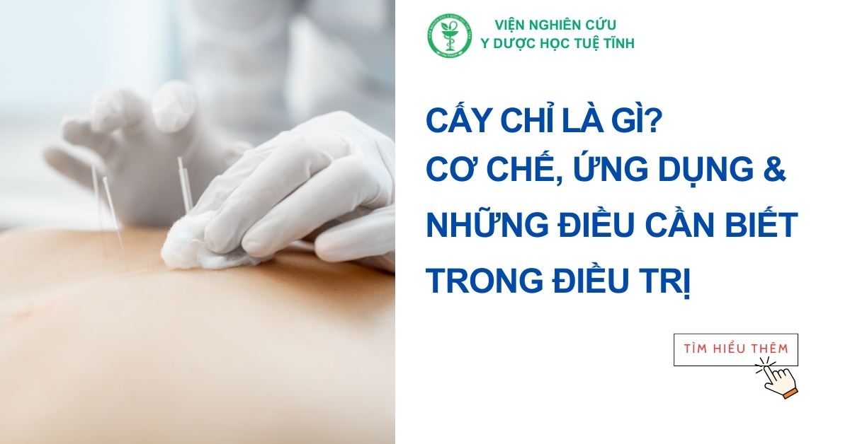 Cấy chỉ là gì? Cơ chế, ứng dụng và những điều cần biết trong điều trị