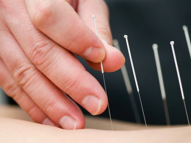 Vai trò của châm cứu trong Y học thể thao