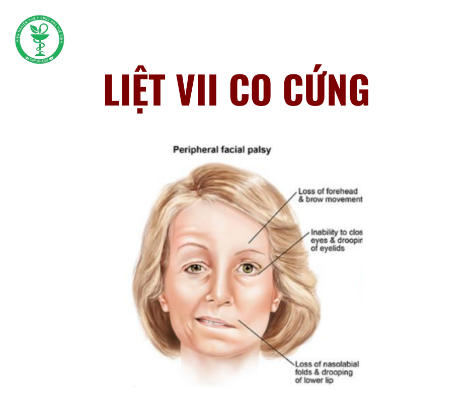 Liệt VII co cứng