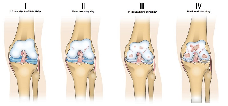 Tổn thương sụn khớp trong bệnh lý thoái hóa khớp