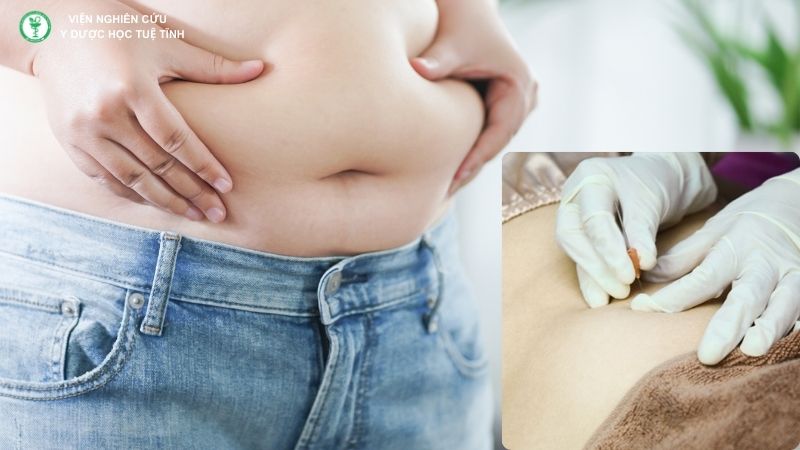Cấy chỉ cho người thừa cân, béo phì