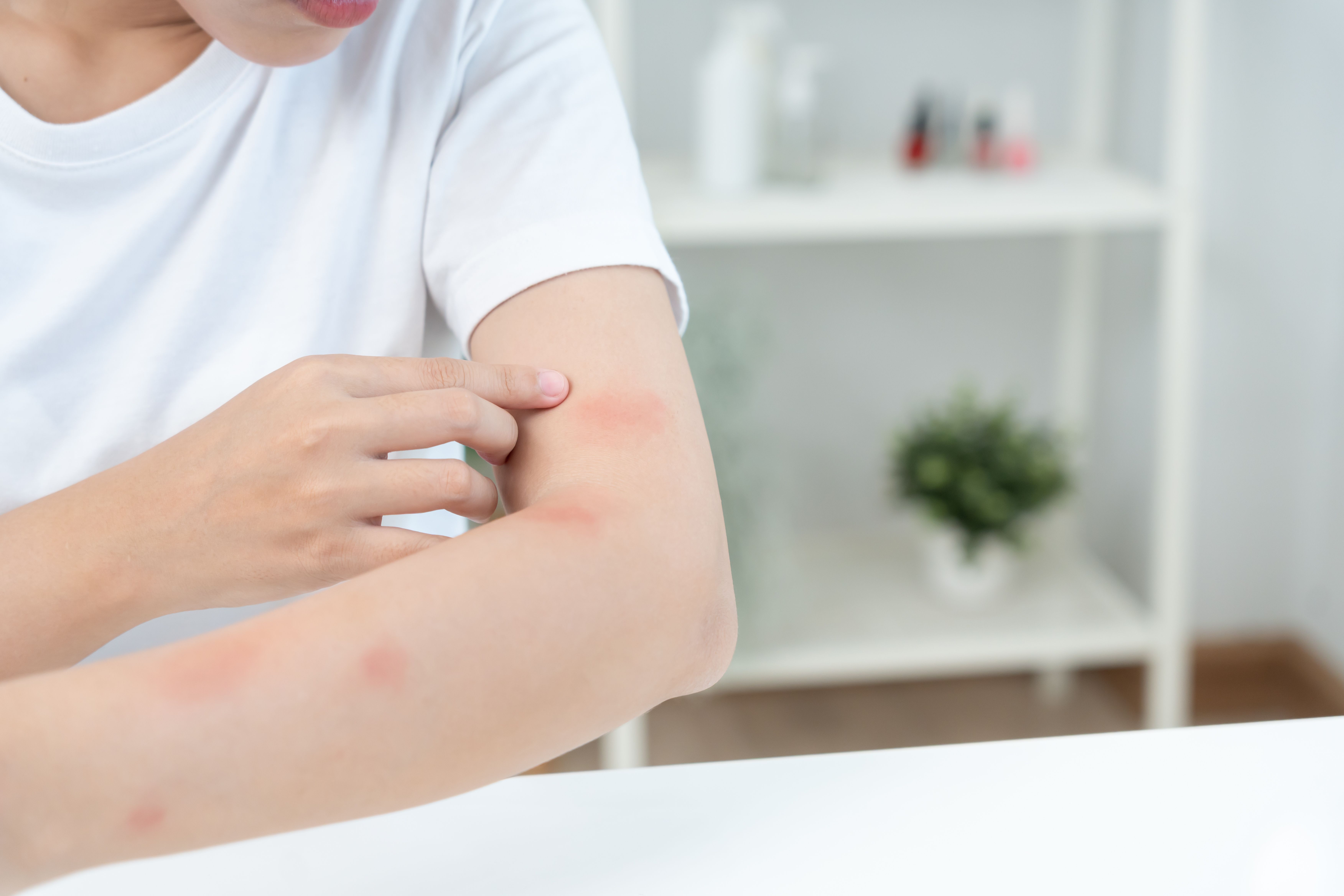 Viêm da là gì? Nguyên nhân, dấu hiệu và cách kiểm soát hiệu quả