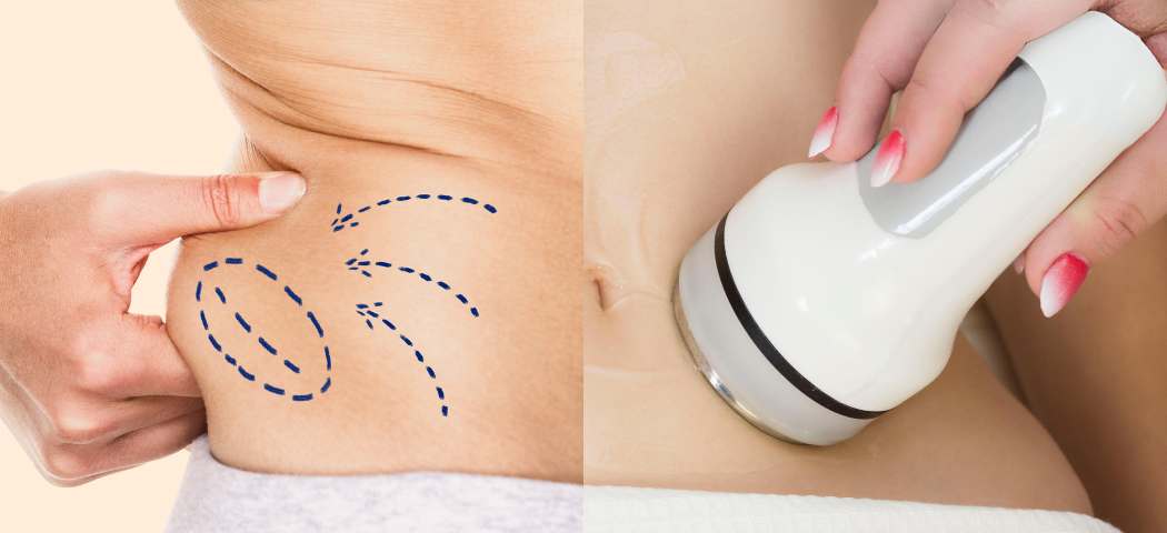 Hút mỡ và giảm cân: Cơ chế khác nhau, ưu nhược điểm và sự thật cần biết trước khi lựa chọn