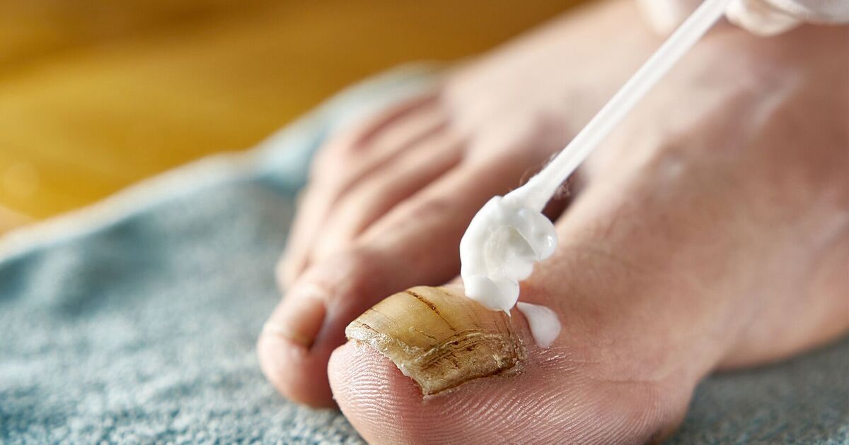 Nấm Kẽ Móng Chân Tay: Dấu Hiệu Nhận Biết, Nguyên Nhân Và Cách Điều Trị Hiệu Quả