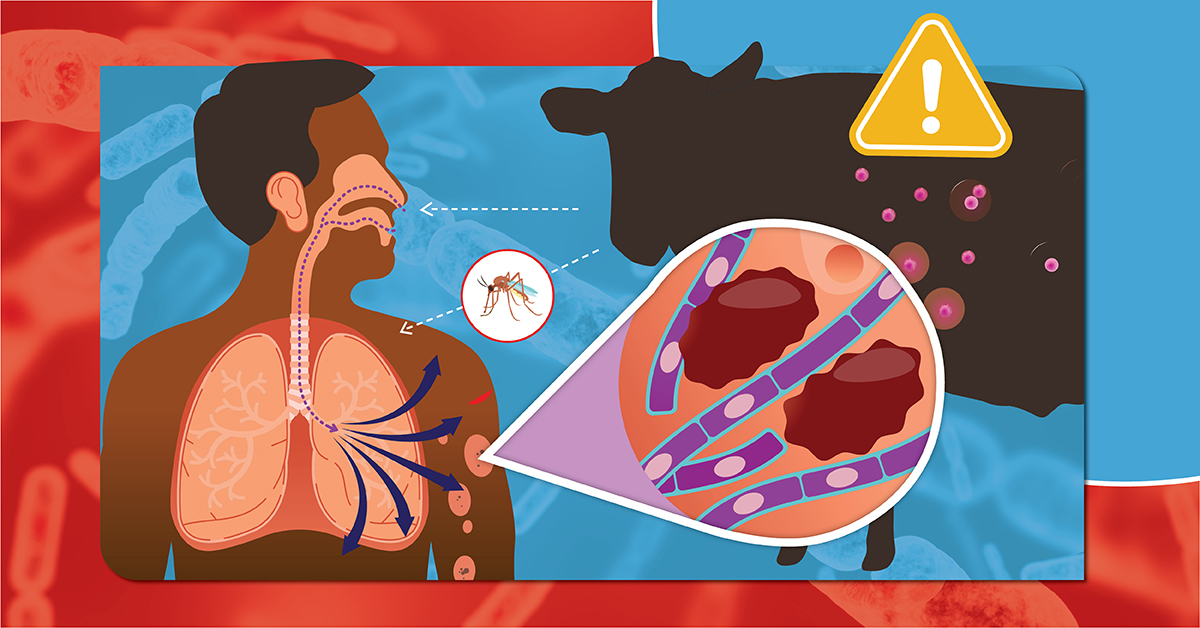 Bệnh than: Nguyên nhân, triệu chứng, mức độ nguy hiểm và cách phòng ngừa hiệu quả