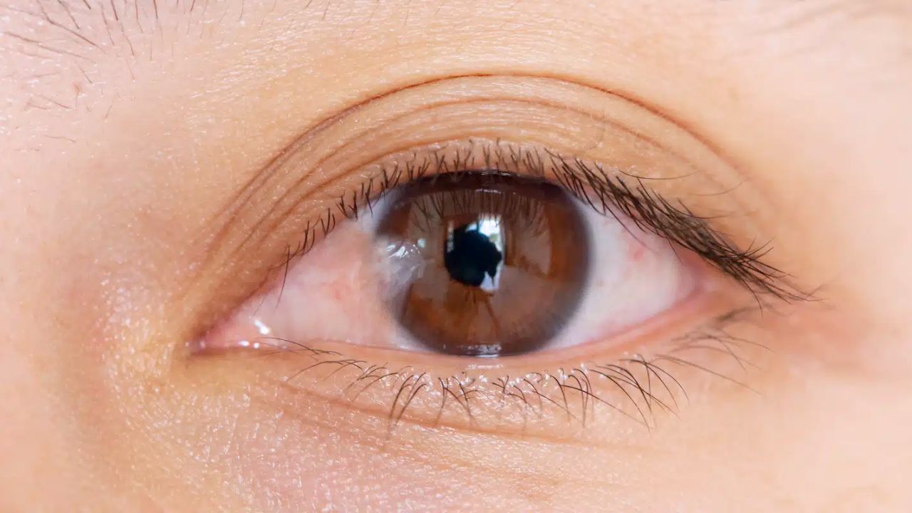 Mộng thịt ở mắt: Nguyên nhân, dấu hiệu và cách điều trị dứt điểm tránh tái phát