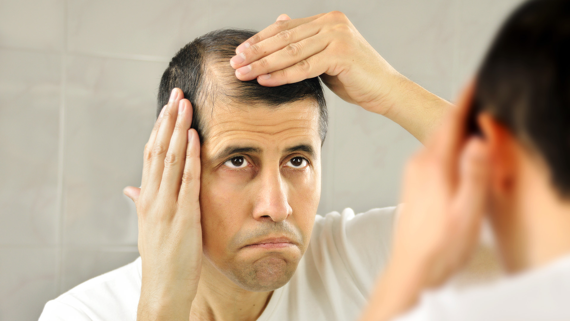 Hói đầu: Nguyên nhân, dấu hiệu và các phương pháp điều trị hiệu quả hiện nay