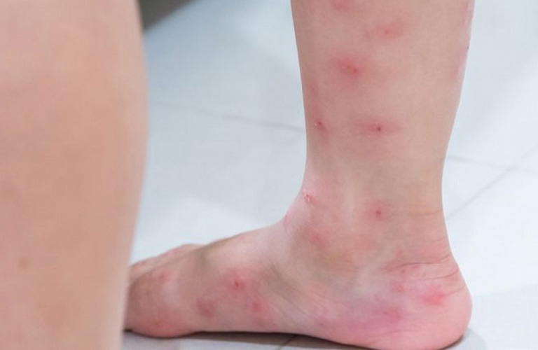Nổi mẩn li ti, ngứa tập trung ở chân, tay, bụng: Dấu hiệu cảnh báo gì cho sức khỏe?