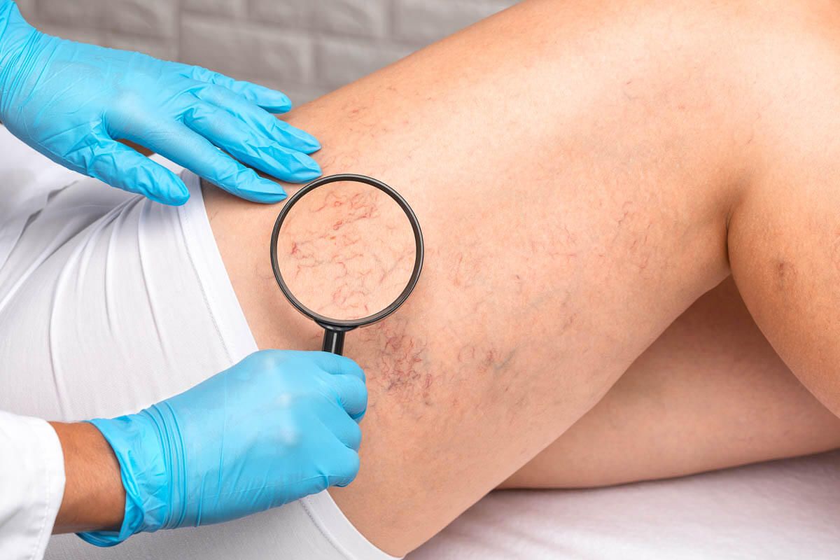 Giãn tĩnh mạch: Nguyên nhân, triệu chứng và cách phòng ngừa hiệu quả