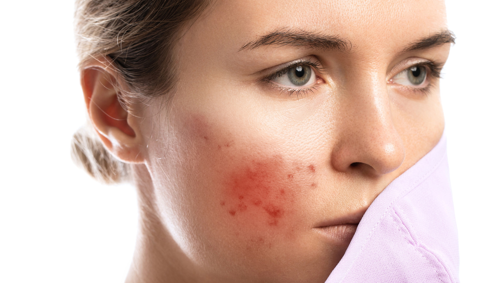 Viêm lỗ chân lông: Nguyên nhân, dấu hiệu và cách điều trị hiệu quả tại nhà