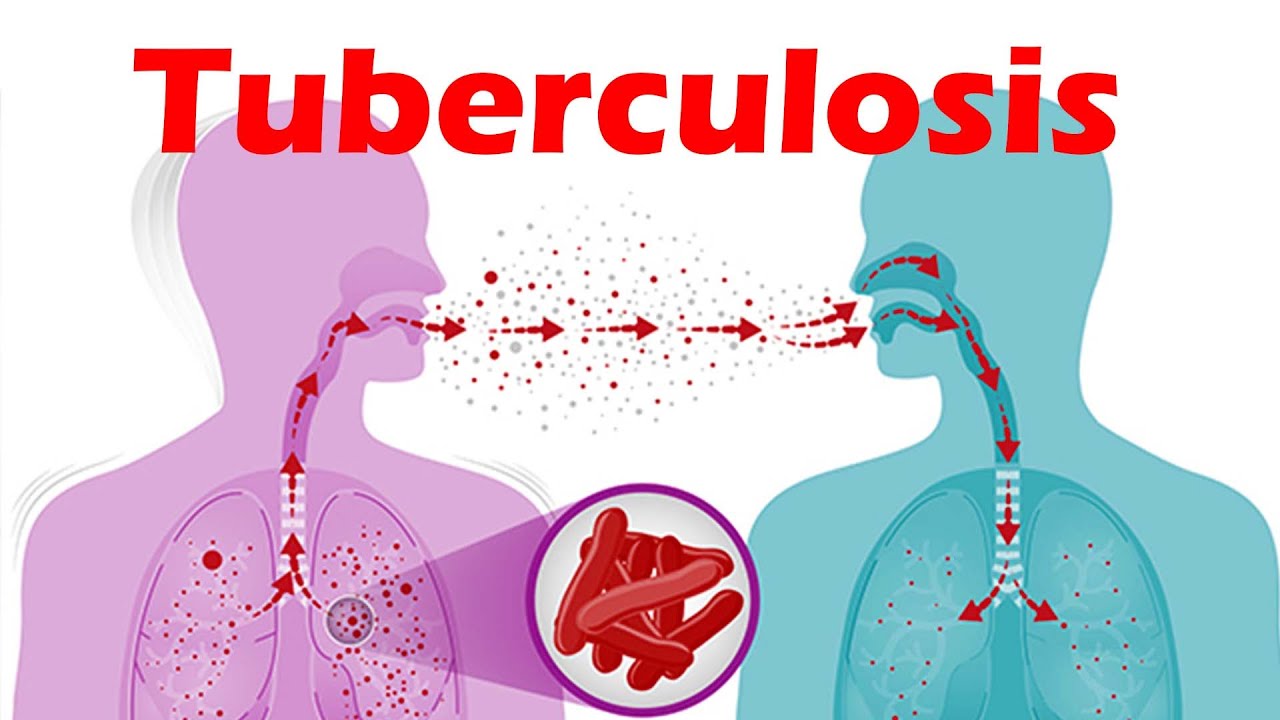 Bệnh Lao: Nguyên Nhân, Triệu Chứng, Cách Phòng Ngừa Và Điều Trị Hiệu Quả