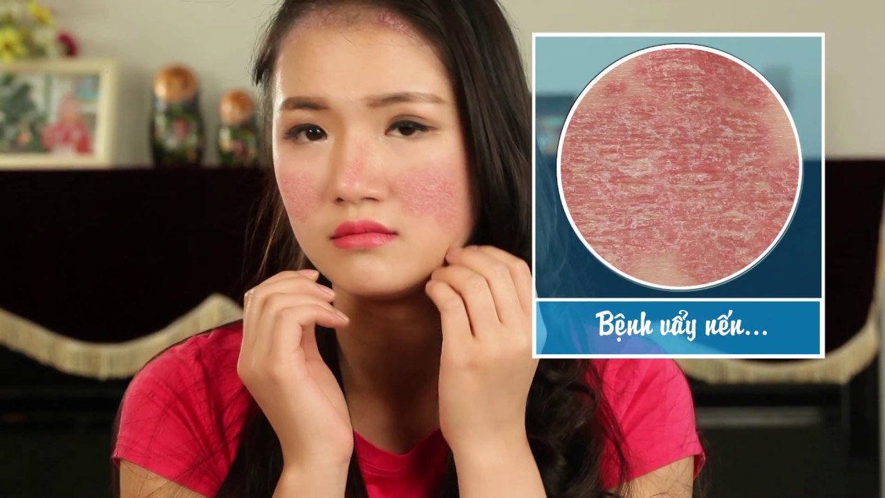 Vẩy nến là gì? Nguyên nhân, triệu chứng và hướng kiểm soát hiệu quả