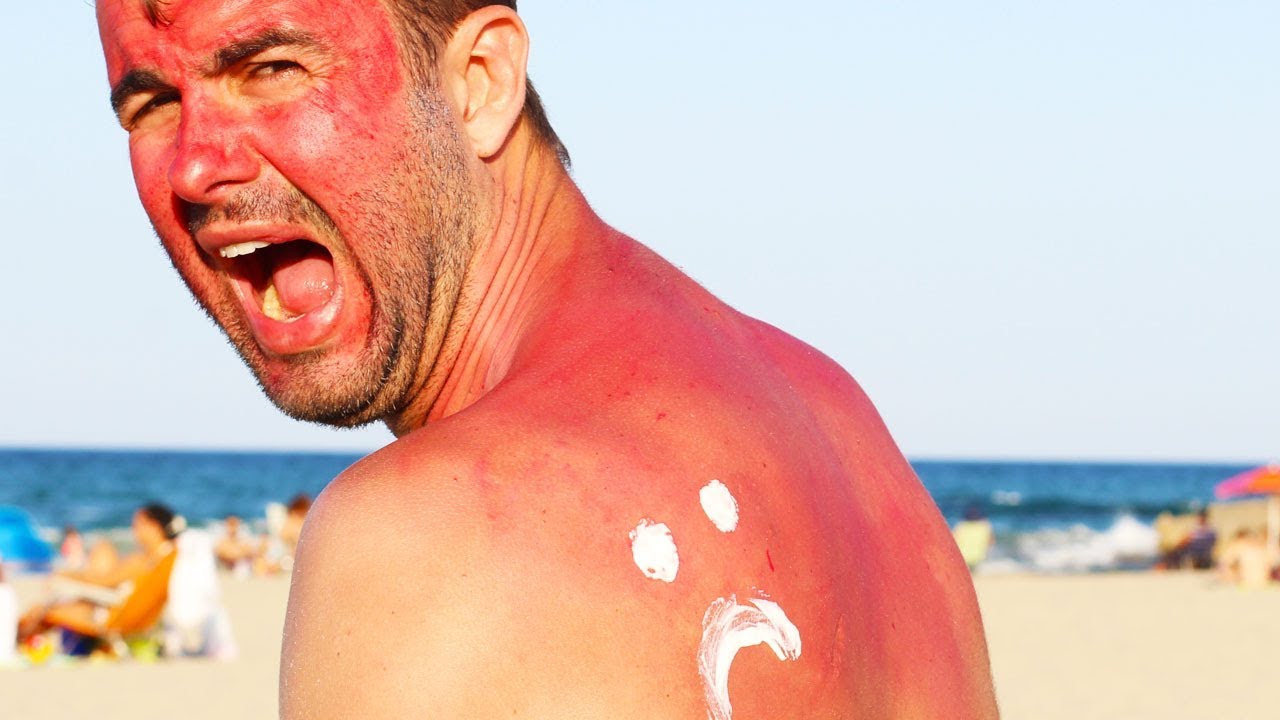 Cách xử trí nhanh khi bị bỏng da, mắt