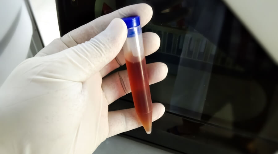 Đi tiểu ra máu: Nguyên nhân, dấu hiệu nguy hiểm và khi nào cần đi khám?