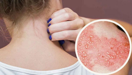 Zona thần kinh: Nguyên nhân, triệu chứng, biến chứng và cách điều trị