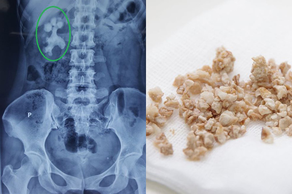 6 thói quen gây sỏi thận, cái thứ 3 người Việt mắc nhiều nhất, ai không có xin chúc mừng