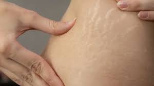 Review 5 kem trị rạn da tuổi dậy thì, tăng cân & do tập gym tốt nhất hiện nay