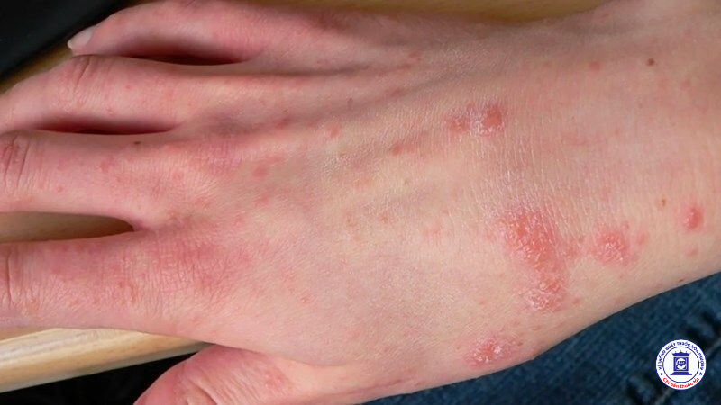 Nguy Cơ Bệnh Da Liễu Sau Mùa Mưa Lũ: Nhận Biết và Biện Pháp Phòng Ngừa Hiệu Quả