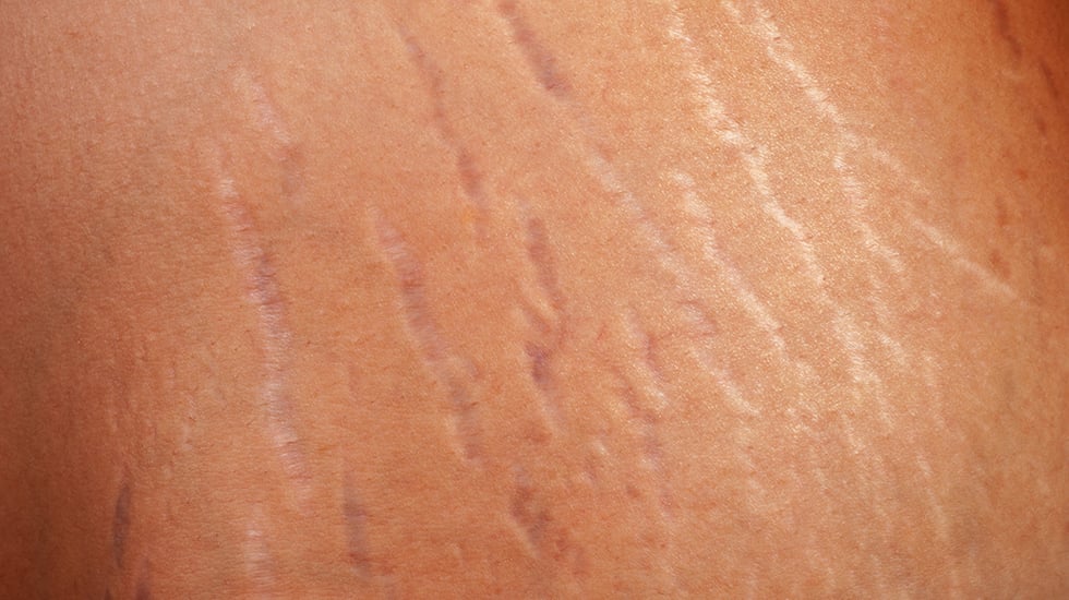 Rạn da đỏ là gì? Rạn da trắng là gì?