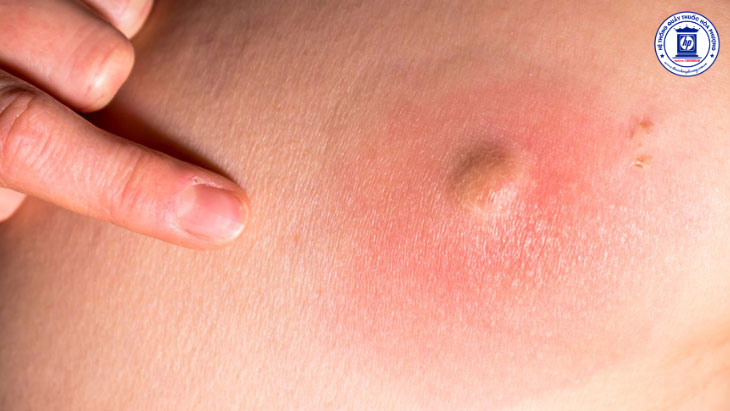 Áp Xe Mông: Nguyên Nhân, Triệu Chứng, Và Cách Điều Trị Hiệu Quả