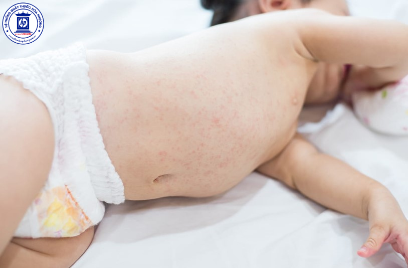 Làm thế nào để ngăn ngừa rôm sảy cho trẻ trong mùa hè này?