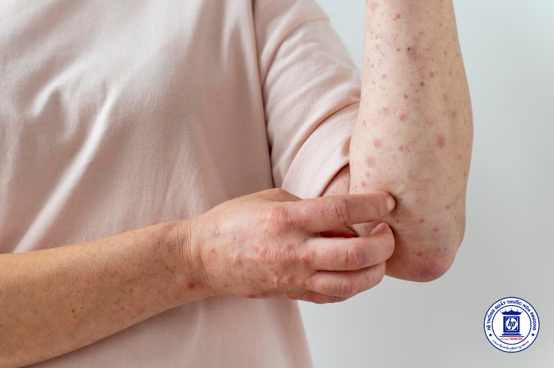 Cảnh Báo: Biện Pháp Cấp Bách Để Phòng Ngừa Sốt Xuất Huyết Sau Mưa Lũ