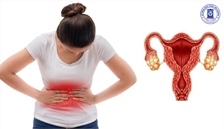 Hiểu Rõ Về Hội Chứng Buồng Trứng Đa Nang: Có Tự Khỏi Được Không?