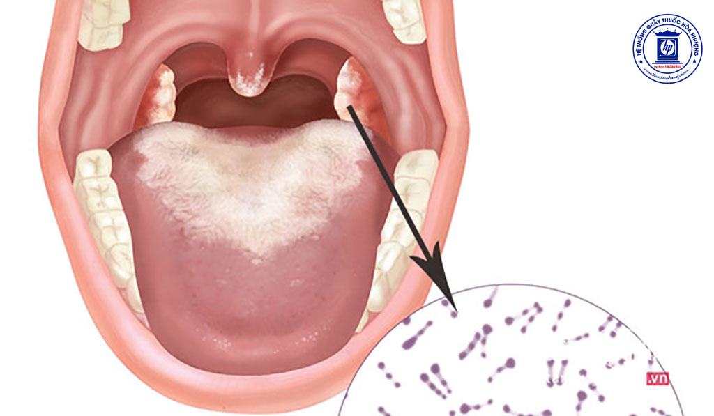 Cảnh Giác và Phòng Ngừa Bệnh Bạch Hầu: Biện Pháp Bảo Vệ Sức Khỏe Cộng Đồng