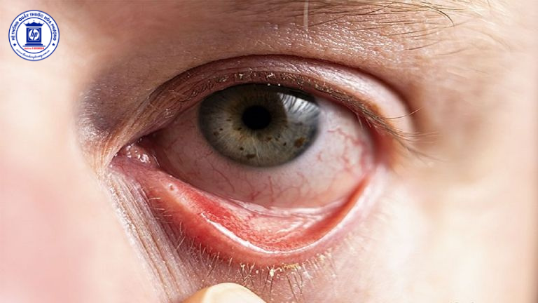 Cách Trị Viêm Giác Mạc Tại Nhà Hiệu Quả: Hướng Dẫn Chi Tiết