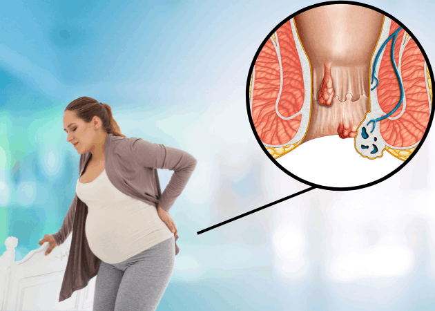 Bệnh Trĩ Khi Mang Thai Có Nguy Hiểm? Cách Điều Trị An Toàn Cho Mẹ Bầu