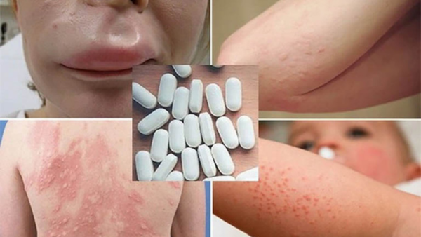 Cách Xử Lý Dị Ứng Thuốc Tại Nhà Hiệu Quả