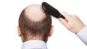 Tìm hiểu về việc rụng tóc, hói đầu do di truyền ở nam giới