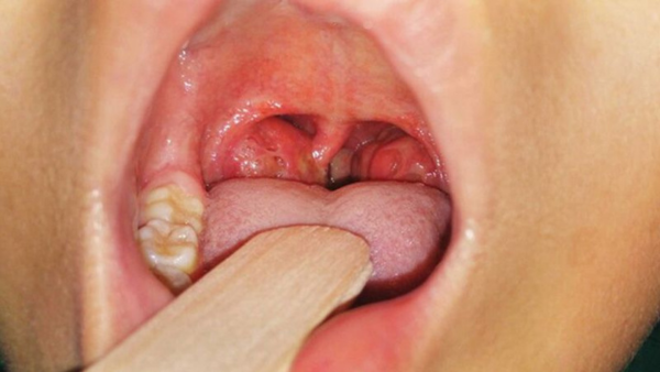 Phân Biệt Viêm Amidan và Viêm Họng
