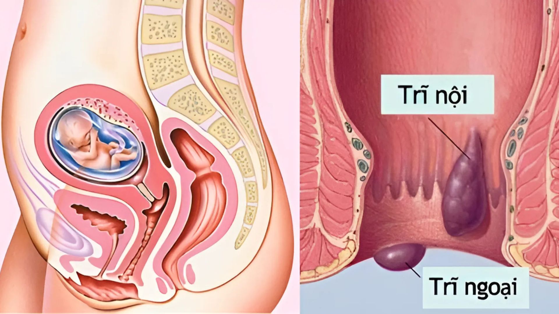 Bệnh Trĩ Khi Mang Thai: Nguyên Nhân, Triệu Chứng và Cách Điều Trị Hiệu Quả Bằng Gel Hemoclin