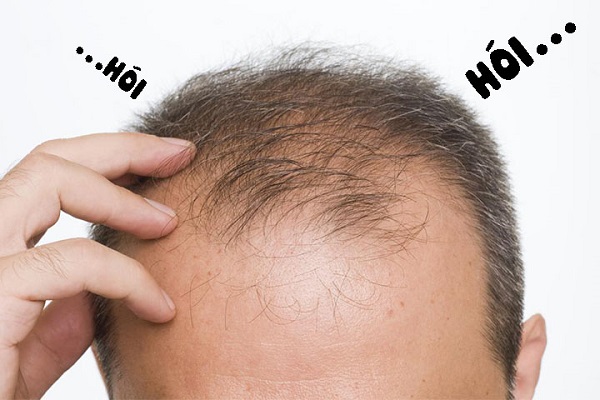Tìm hiểu về việc rụng tóc, hói đầu do di truyền ở nam giới BEEKING