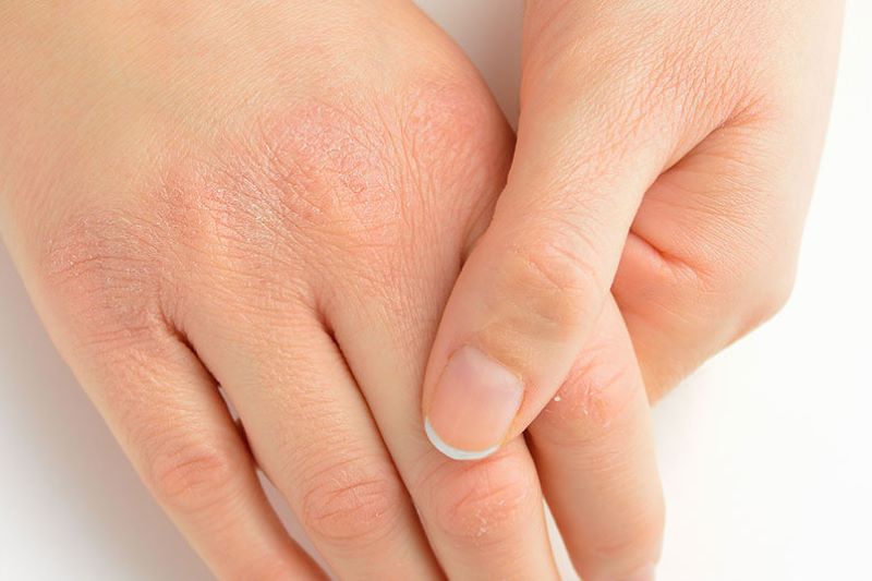 Những biểu hiện của da tay khi tiếp xúc với nguồn nước máy dư clo