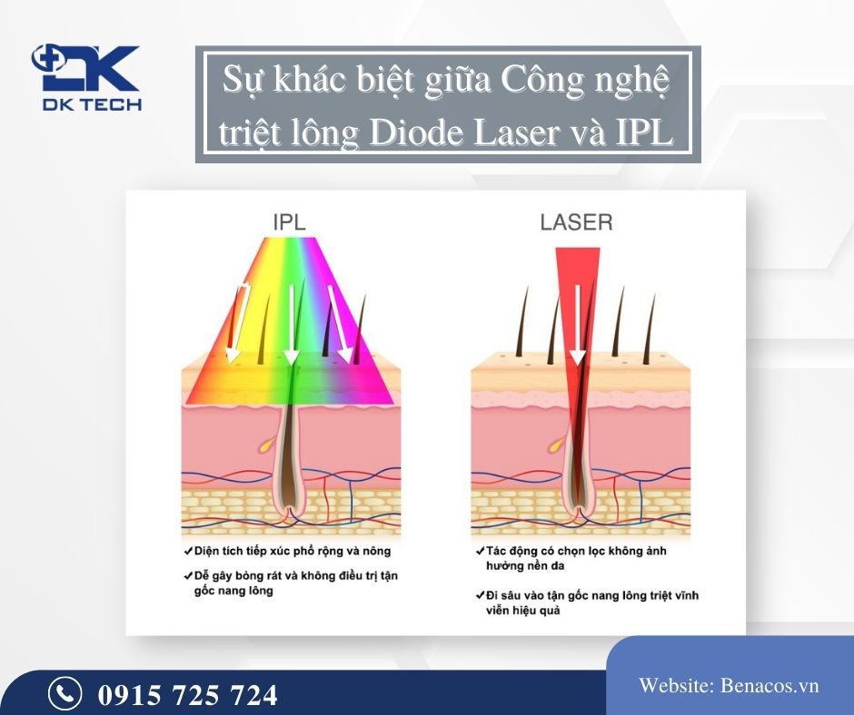 Sự khác biệt giữa Công nghệ triệt lông Diode Laser và IPL
