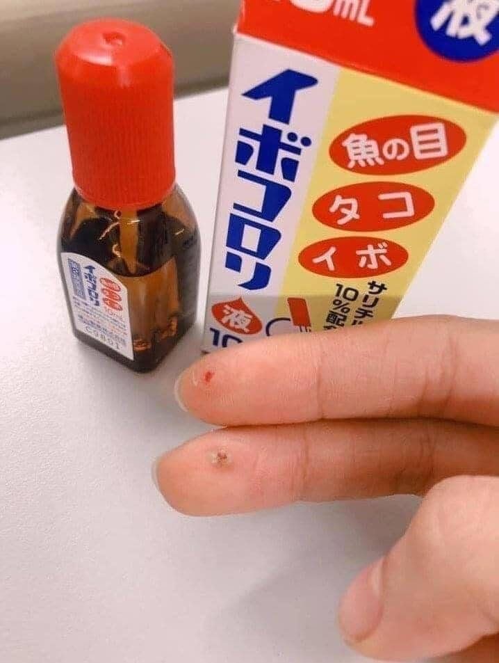 Dung dịch trị mụn cóc