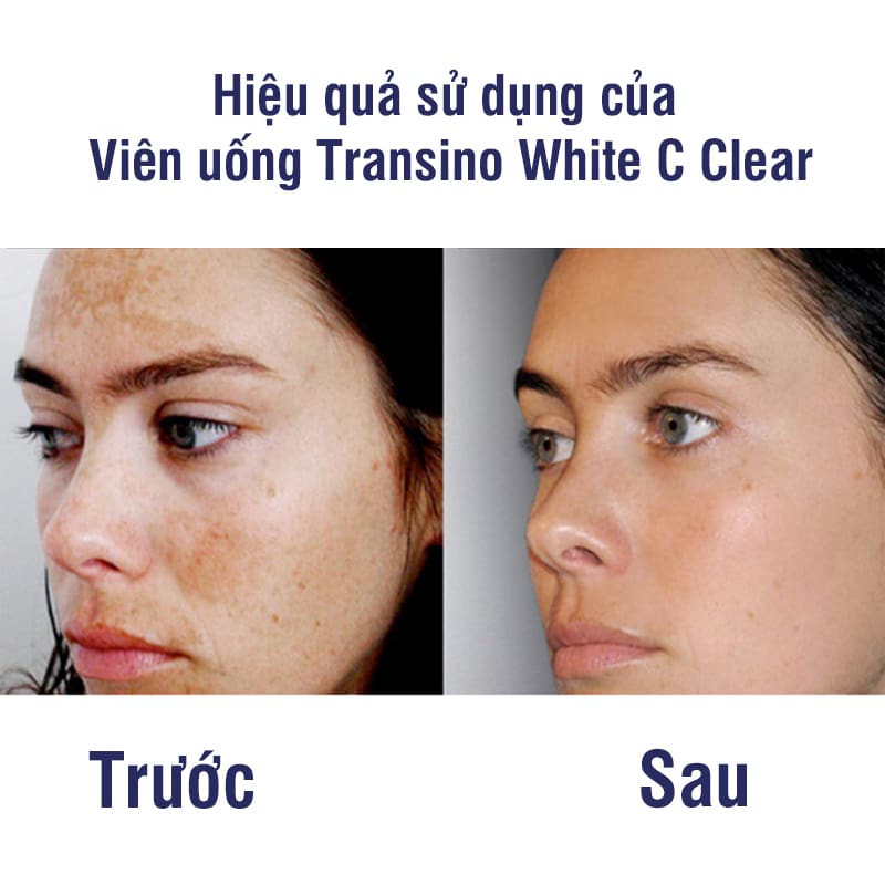 Viên uống trị nám Transino white 120 viên (Xanh)