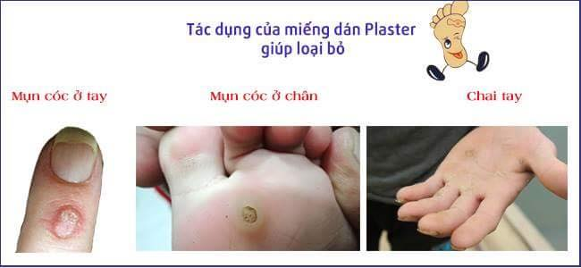 Miếng Dán Trị Mụn Cóc Ibokorori Size M 12 miếng