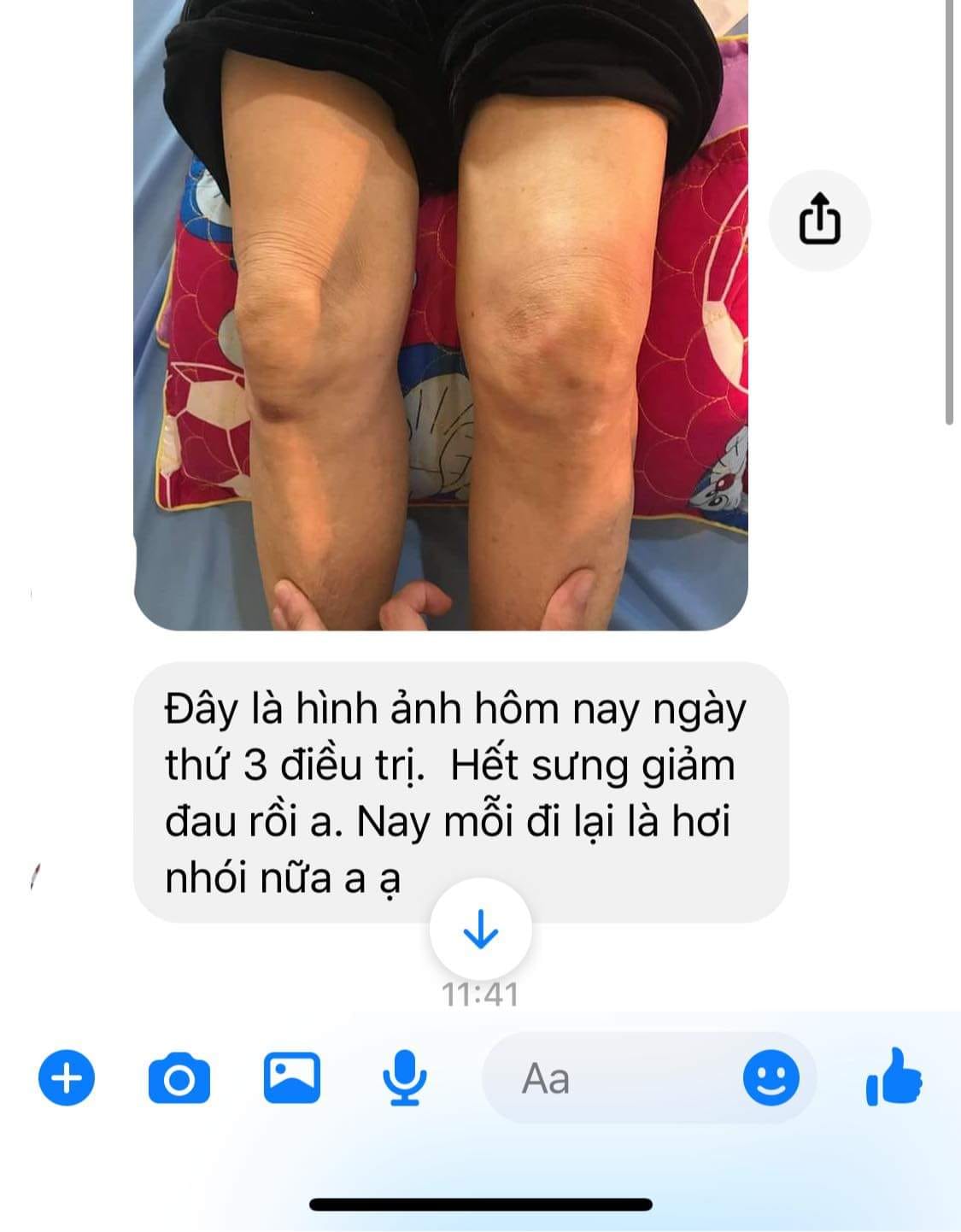 CAO ĐẮP XƯƠNG KHỚP CẤP TÍNH ( VIÊM, SƯNG, TRÀN DỊCH KHỚP)
