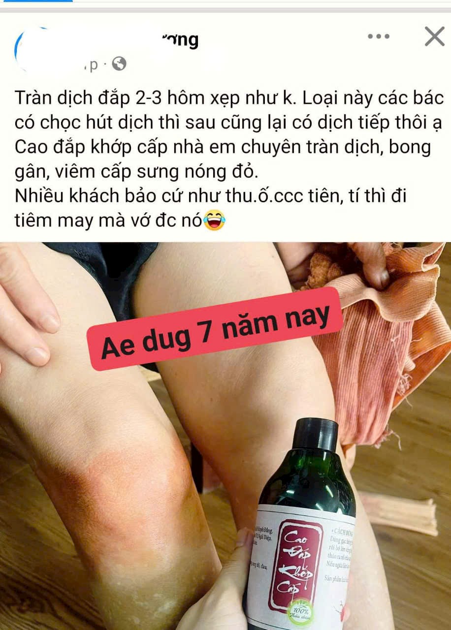 CAO ĐẮP XƯƠNG KHỚP CẤP TÍNH ( VIÊM, SƯNG, TRÀN DỊCH KHỚP)