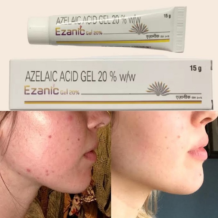 Gel  - Kem dưỡng Giảm mụn , Mờ Thâm , Dưỡng Sáng Da Ezanic 20% Azelaic Acid 15g