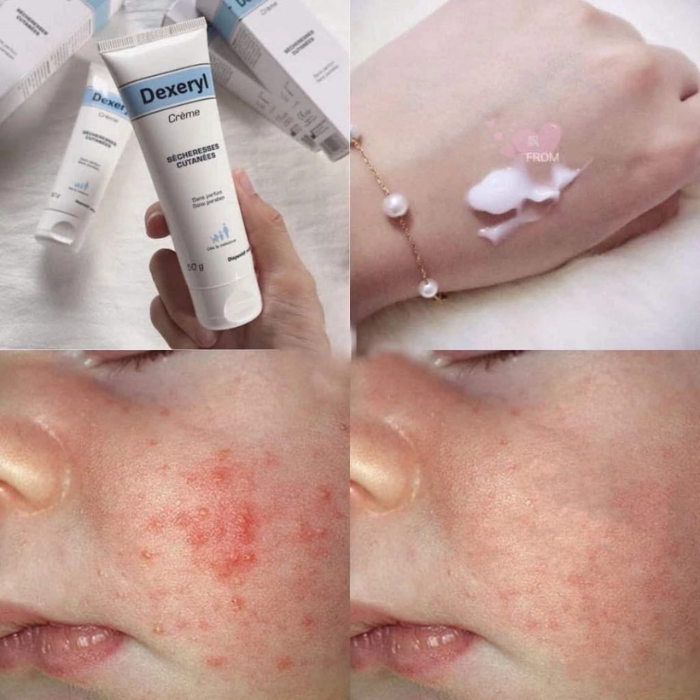 Kem dưỡng da ngừa nẻ, chàm sữa cho trẻ và gia đình Dexeryl 250g