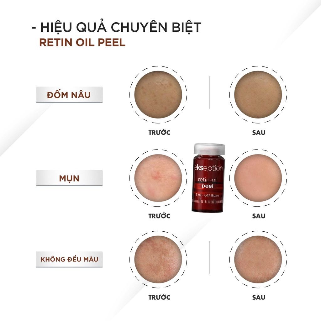 Tinh Chất Làm Sạch Tế Bào Chết, Giảm Mụn Ekseption Retin-oil Peel Hộp 5 Lọ x 5ml