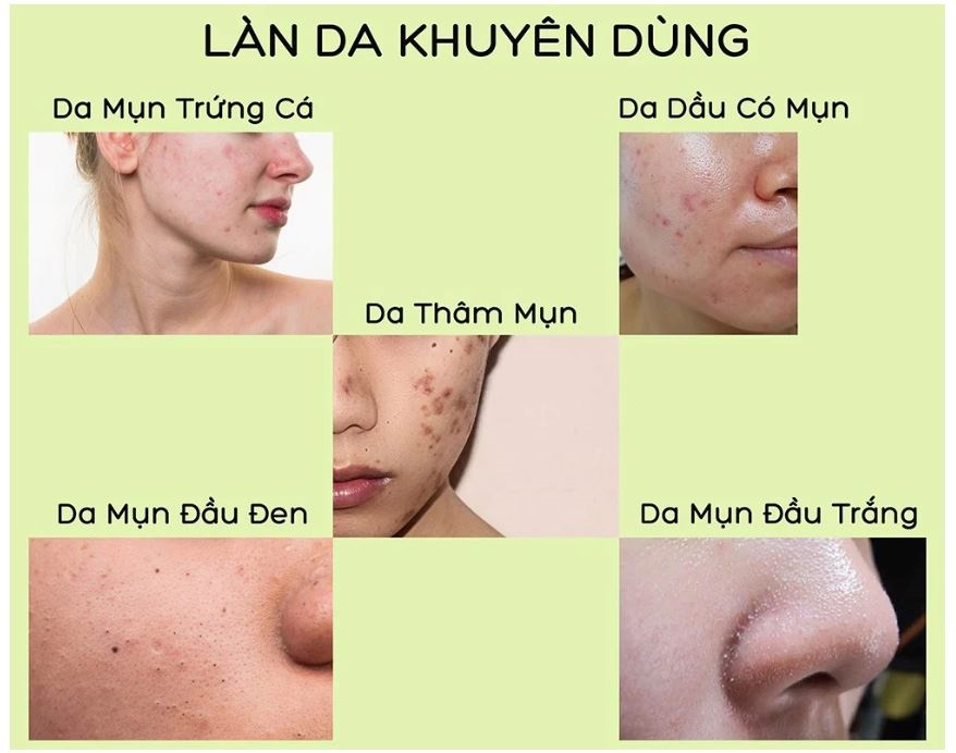 Kem Dưỡng Trị Mụn, Kiểm Soát Dầu SVR Sebiaclear Active Gel 40ml