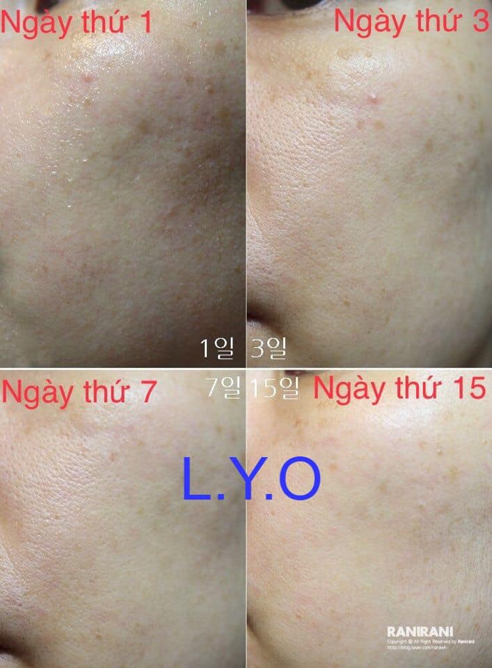 d850 - Kem dưỡng trắng da giảm thâm nám tàn nhang Dongsung Rannce Cream 70g