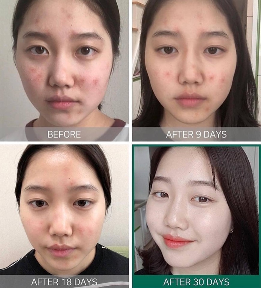 d877 - Tinh chất Some By Mi AHA-BHA-PHA 30 Days Miracle Serum 50ml