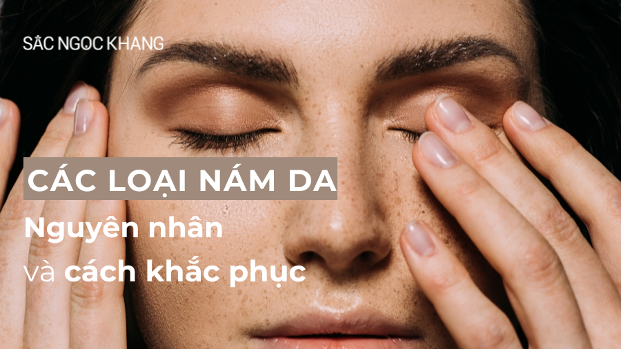 Các loại nám da: Nguyên nhân, đặc điểm và cách khắc phục